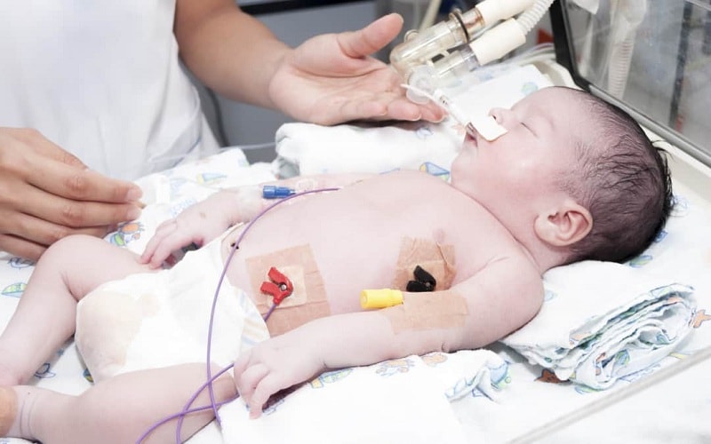 Neonatal pneumothorax admitted to the nicu neonatal intensive care unit